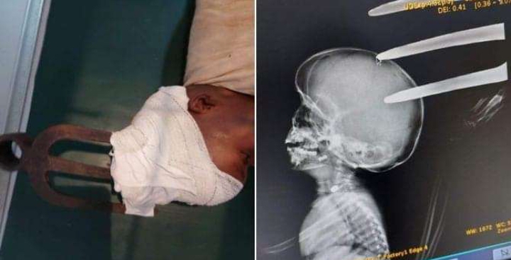 KNH: Baby Travis was hit with fork jembe by his dad, not 6-year-old brother