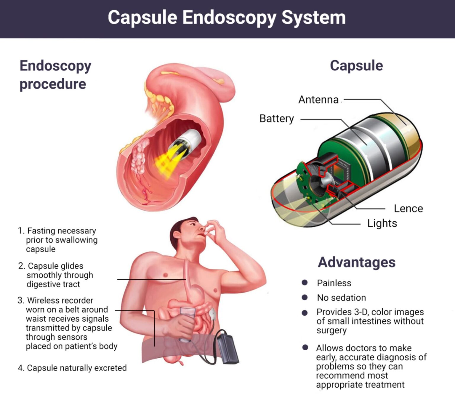 You can now have a capsule for an endoscopy and colonoscopy procedure