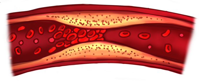 Having an operation done? Know your risk of clotting - Bizna Kenya