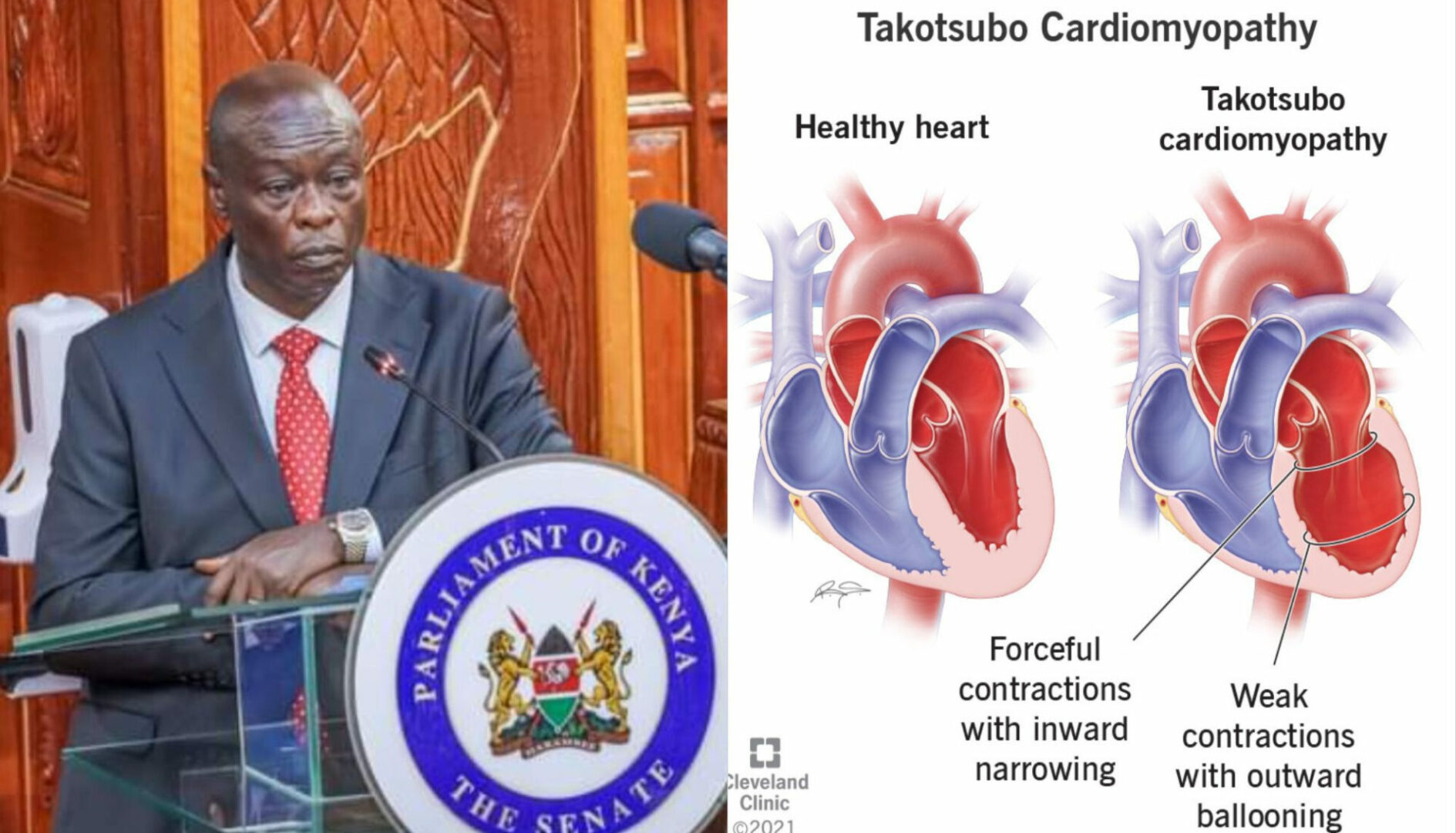 Details of Gachagua's 'broken heart' condition, symptoms, treatment