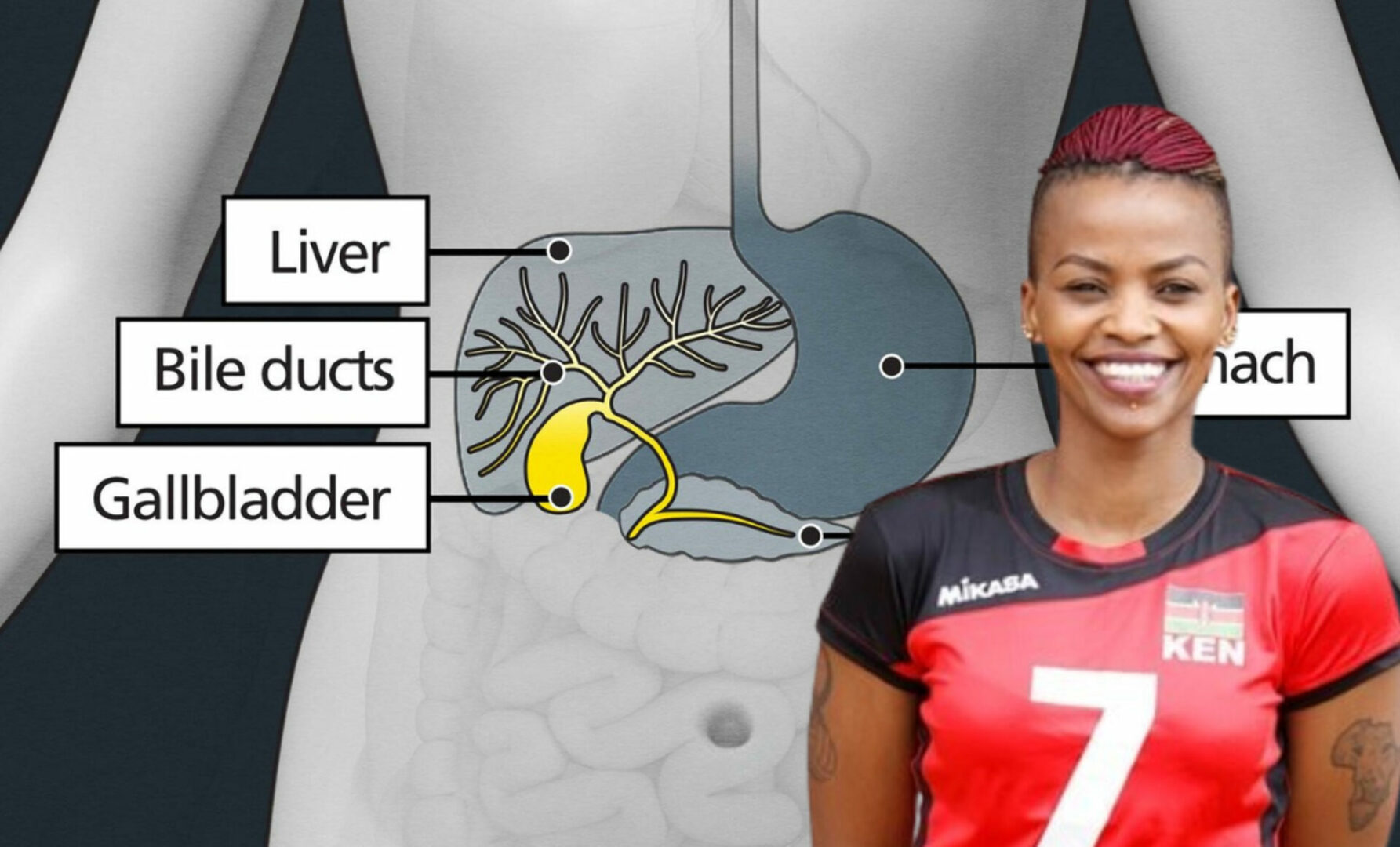 Gallbladder Cancer: Rare disease that killed volleyballer Janet Wanja