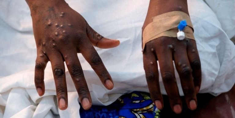 Mpox: What it is, causes, symptoms, treatment and prevention