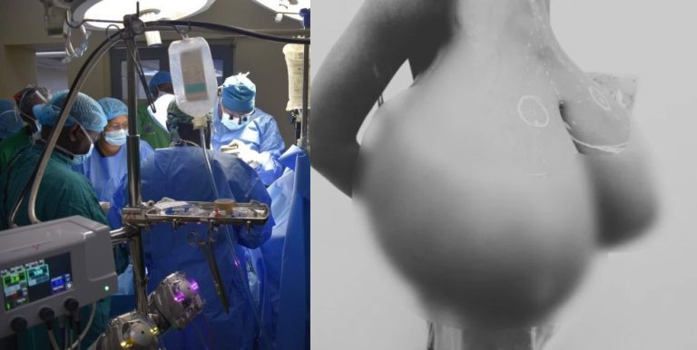Kitui teen relieved after KNH surgeons remove 20kg breast tissue